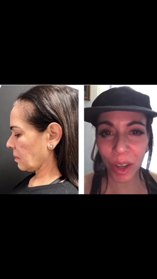 Video by Dr. Andrew Jacono: just got this video 3 months post-op after I performed a on this 59 year old patient from Rome .…