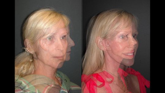 Video by Dr. Andrew Jacono: Today I was so excited to see this 56-year-old patient of mine 3 months after her deep plane face…