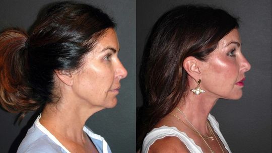 Video by Dr. Andrew Jacono: I just saw this beautiful 61-year-old patient of mine only 9 months after I performed her facial…