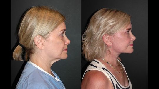 Video by Dr. Andrew Jacono: Today I saw this beautiful 60 year old patient of mine 4 months after her Plastic Surgery. I love…