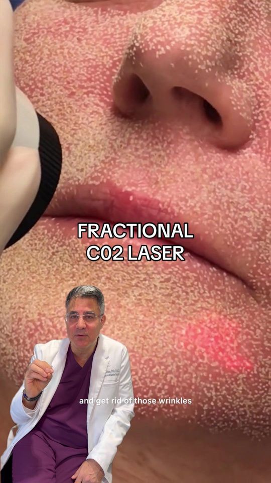 Video by Dr. Andrew T. Cohen: We call this the workhorse for facial rejuvenation! Have any questions? Let us know or call 310-6…