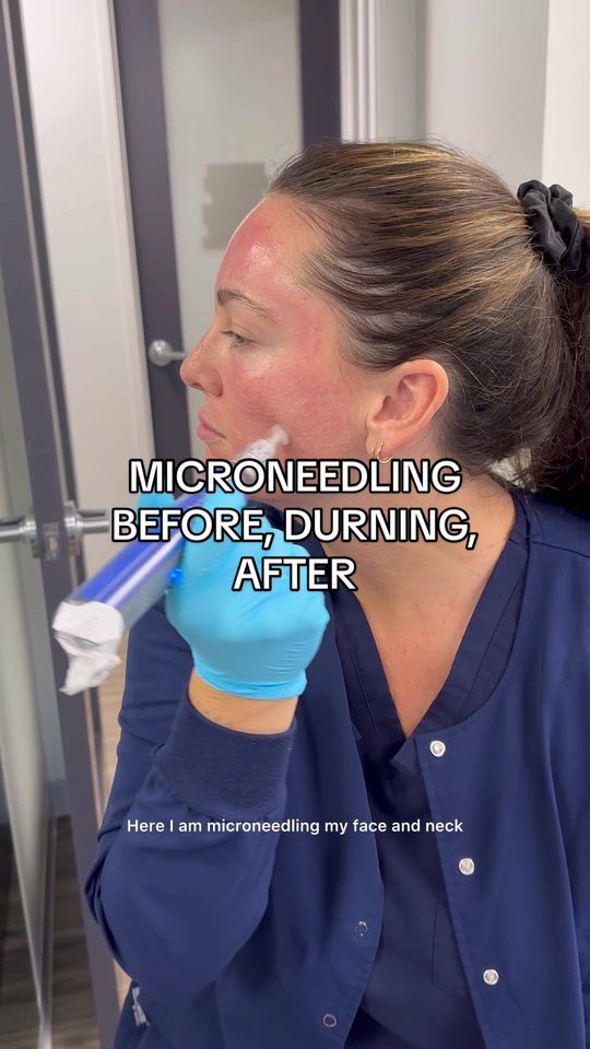 Video by Dr. Andrew T. Cohen: Nurse Alana Explains ✨ MICRONEEDLING What would you like to see next? Comment below👇