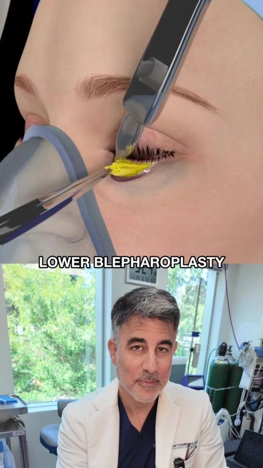 Video by Dr. Andrew T. Cohen: Ever wondered how lower eyelid surgery works? 👁️ This animation shows exactly how we smooth out…