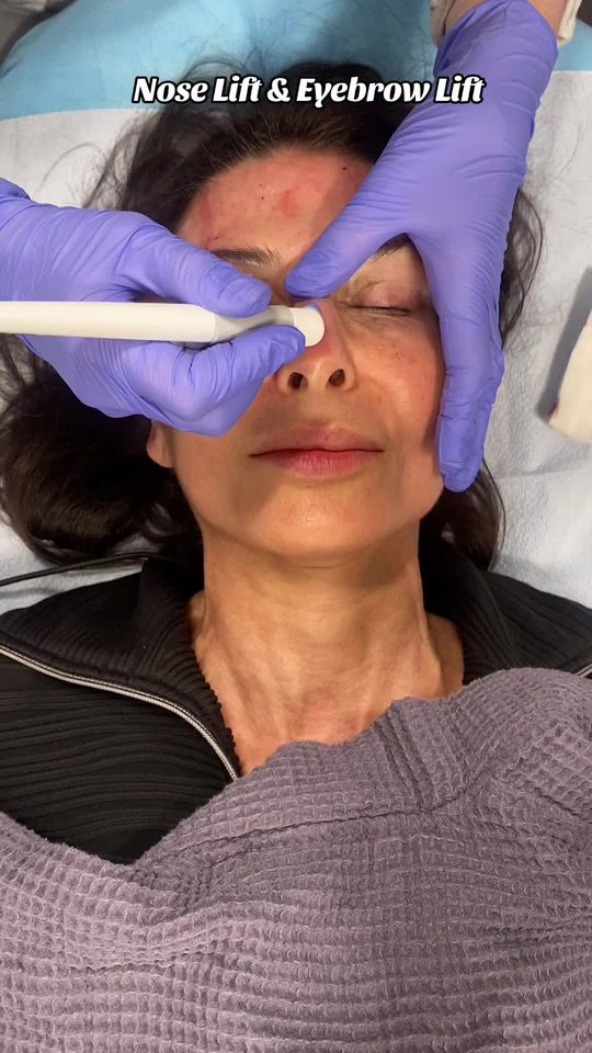 Video by Dr. Anna Petropoulos: Dr. P getting a nose and brow lift with the machine at the Clear Skin Institute in Phoneix, Arizo…