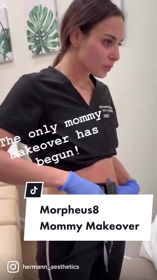 Video by Dr. Anne Hermann: Take a peak at @MichelleMinconePA’s mommy makeover journey with She treated her face, neck & abdo…