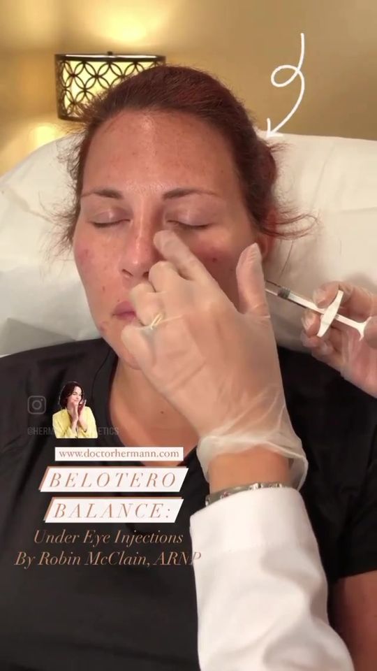 Video by Dr. Anne Hermann: Belotero Balance, is a lightweight filler that is generally injected into the upper layer of the…
