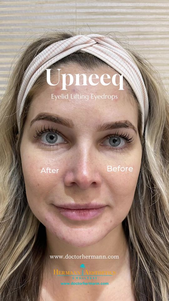 Video by Dr. Anne Hermann: If your eyes look and feel tired because you have droopy upper eyelids (ptosis), Upneeq is a new,…