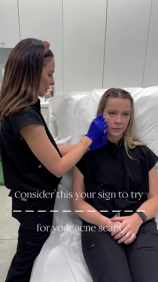 Video by Dr. Anne Hermann: These acne scar improvement results after one month from just one treatment with @SKINVIVE by @Ju…