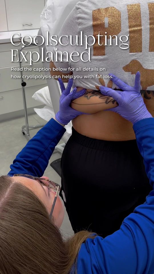 Video by Dr. Anne Hermann: CoolSculpting delivers precisely controlled cooling to gently and effectively target the fat cell…
