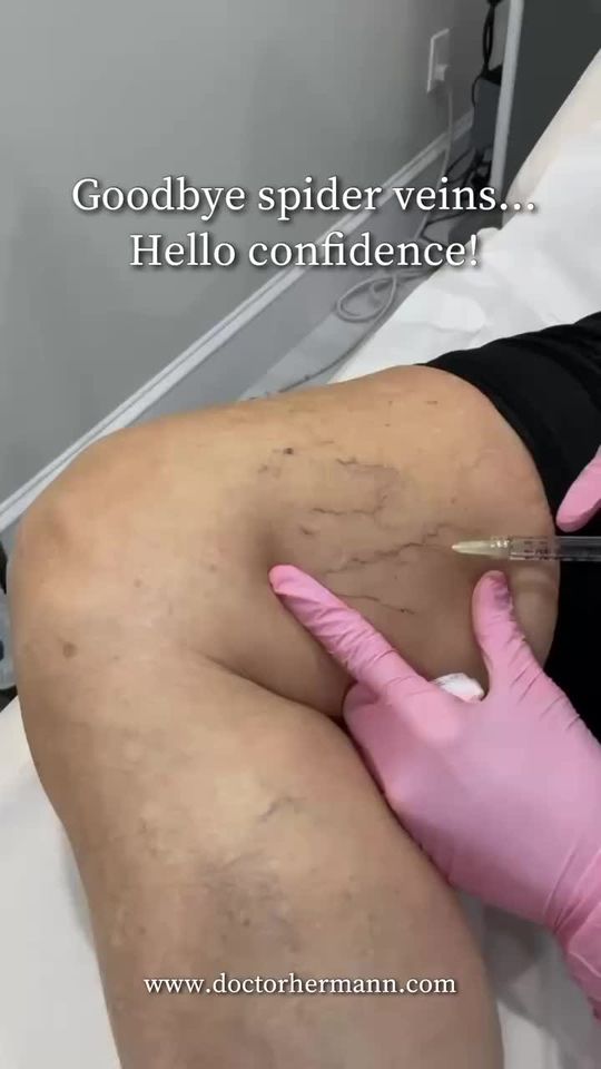 Video by Dr. Anne Hermann: Tired of dealing with spider veins? 😩 Our sclerotherapy treatment is quick, virtually painless,…