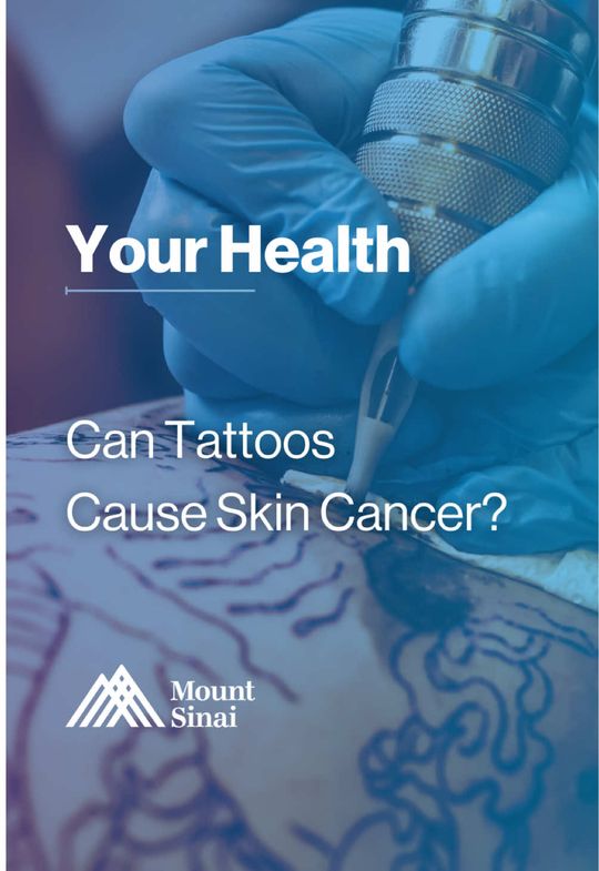 Video by Dr. Anne M. Chapas: Can tattoos cause skin cancer? A recent study published in January examined Danish twins to explo…