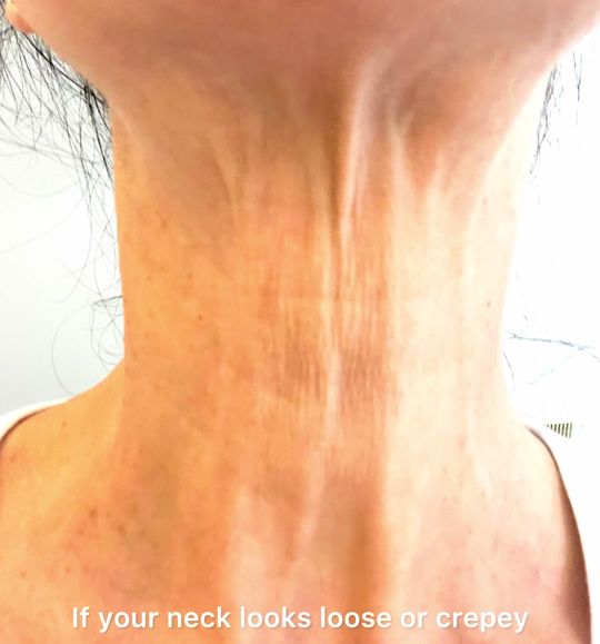 Video by Dr. Arisa Ortiz: Radiesse for loose neck skin!