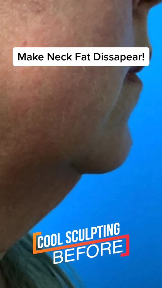Video by Dr. Ben Behnam: Neck Fat Disappears as Dr. Ben Behnam performs Cool Sculpting on a patient.