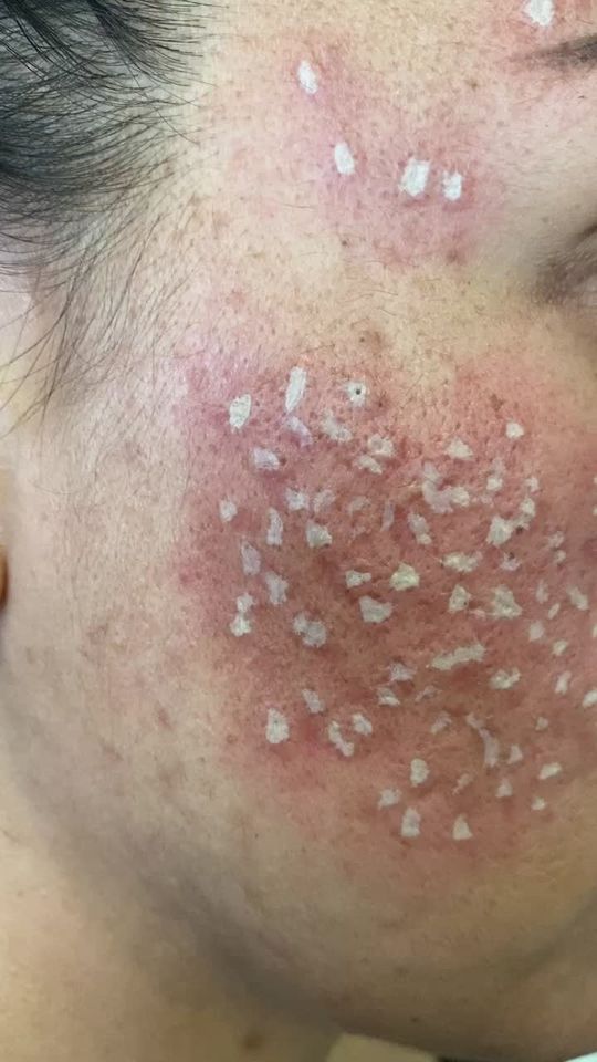 Video by Dr. Ben Behnam: TCA acne scars