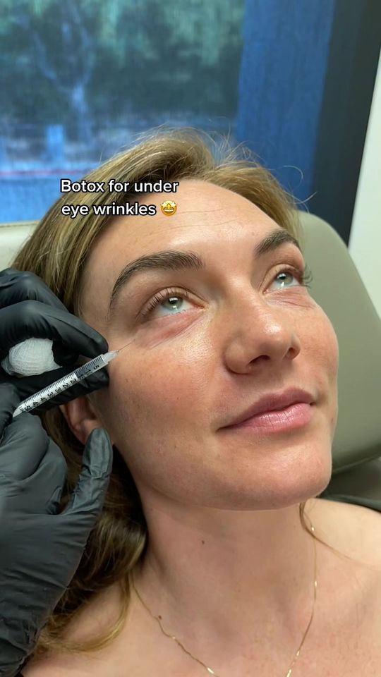 Video by Dr. Burr von Maur: Botox injections around the lower eyelid may decrease under eye puffiness && can also help reduce…