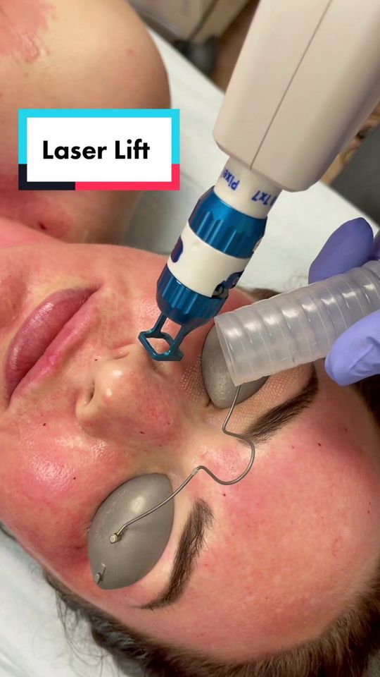 Video by Dr. Burr von Maur: Skin Resurfacing with Lasers 💙
