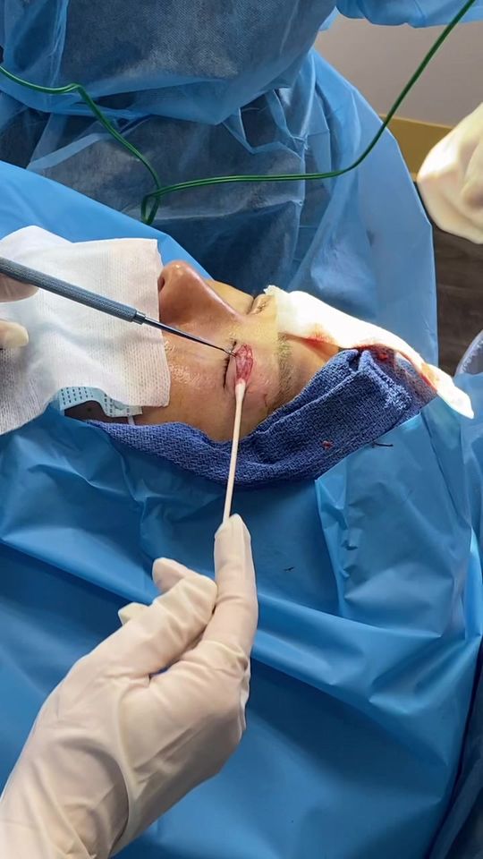 Video by Dr. Chase Lay: Double eyelid surgery pt. 2 ;)
