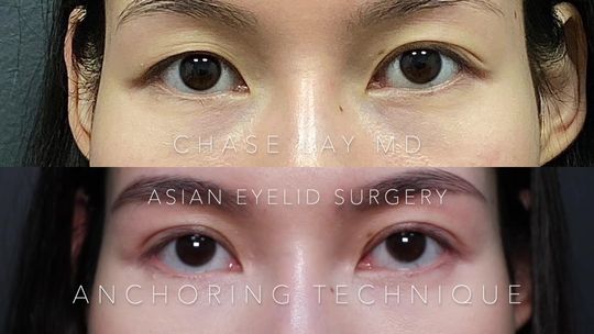Video by Dr. Chase Lay: anchoring technique!