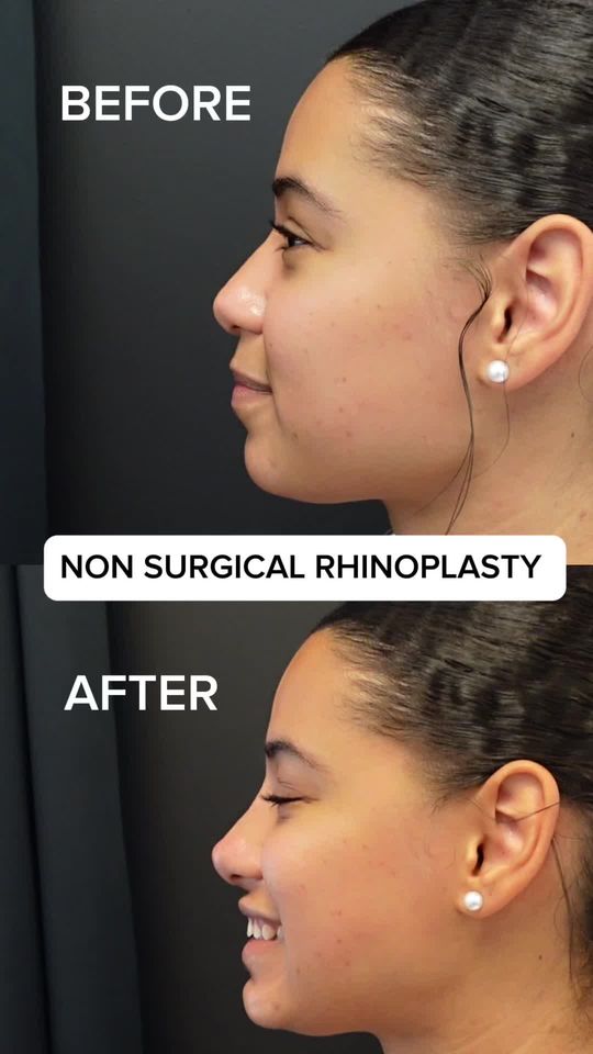 Video by Dr. Chase Lay: Before and after of nurse Emily’s beautiful work on this lovely patient! This patient wanted to m…