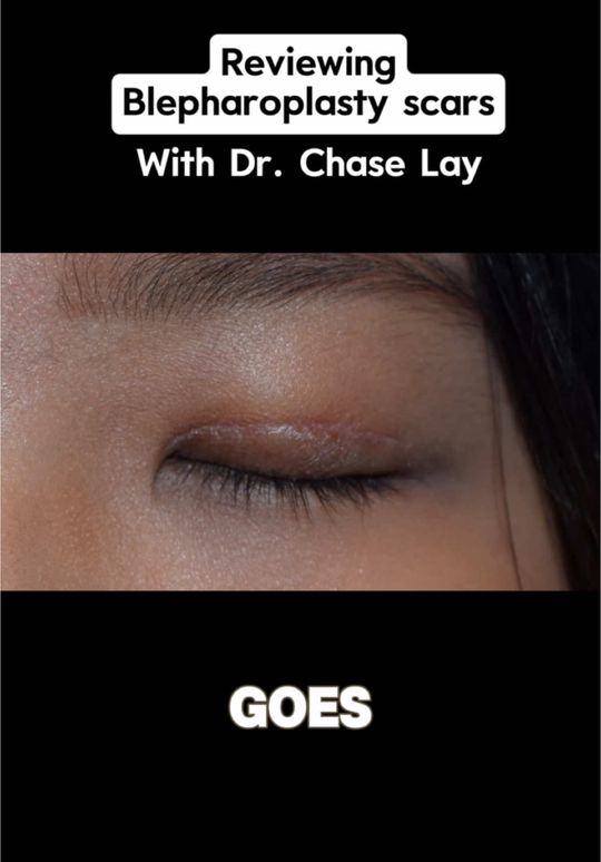 Video by Dr. Chase Lay: In the 15 years that I’ve been performing Asian eyelid surgery and other types of blepharoplasty,…