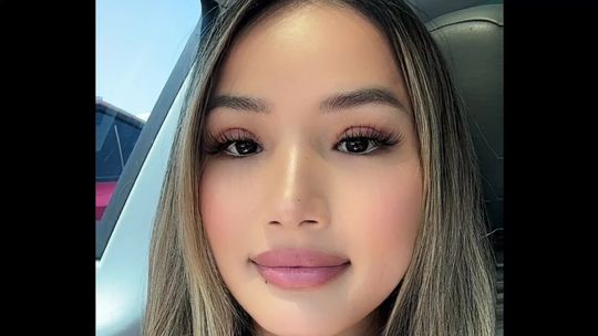 Video by Dr. Chase Lay: Post-op day 10 result asian eyelid surgery, incision technique by Chase Lay MD. Most patients don…