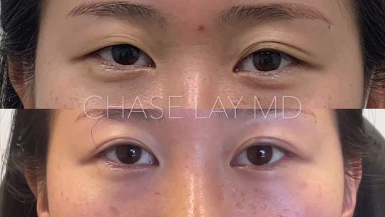 Video by Dr. Chase Lay: This patient is over two years postop from Asian eyelid surgery with Chase Lay,MD. This is an asy…
