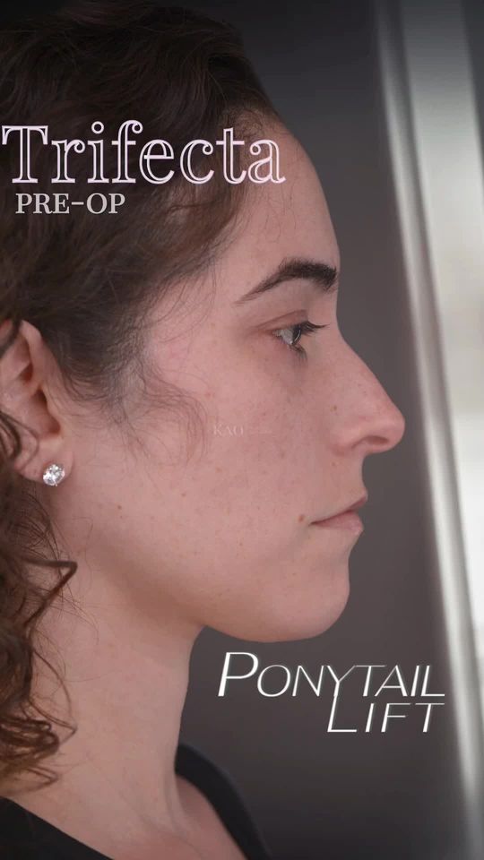 Video by Dr. Chia Chi Kao: Ponytail Lift And The Trifecta of Beauty: Pre-Op - She’s concerned about her face dropping as she…