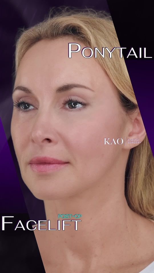 Video by Dr. Chia Chi Kao: She is 51 years old. She had a 3 years ago and now she looks as good as she feels! All without th…