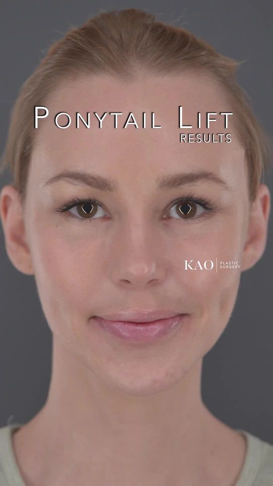 Video by Dr. Chia Chi Kao: Transforming Lives One Ponytail Lift at a Time At KAO Plastic Surgery we're dedicated to helping…