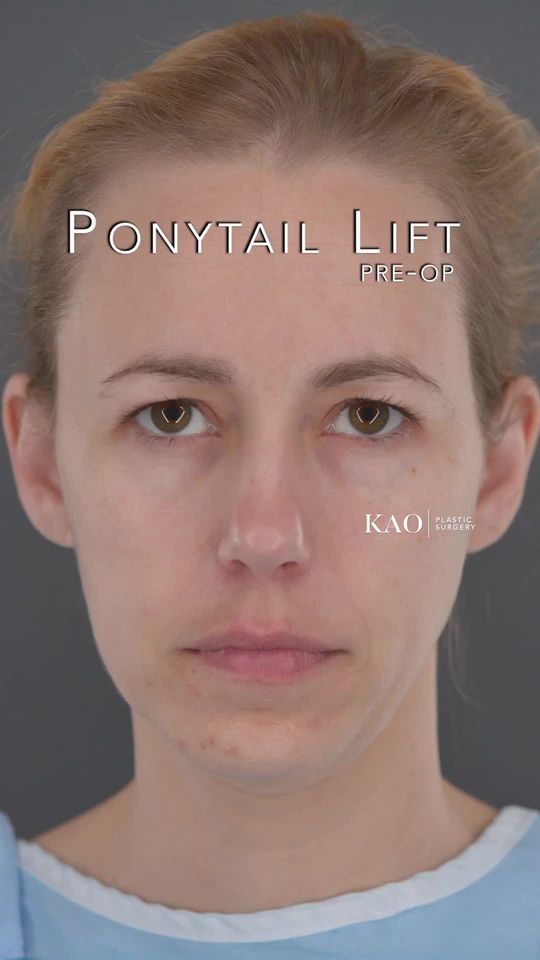 Video by Dr. Chia Chi Kao: "Ponytail Lift & Brow Fashioning Consultation: Enhancing Natural Beauty" In this pre-op consultat…