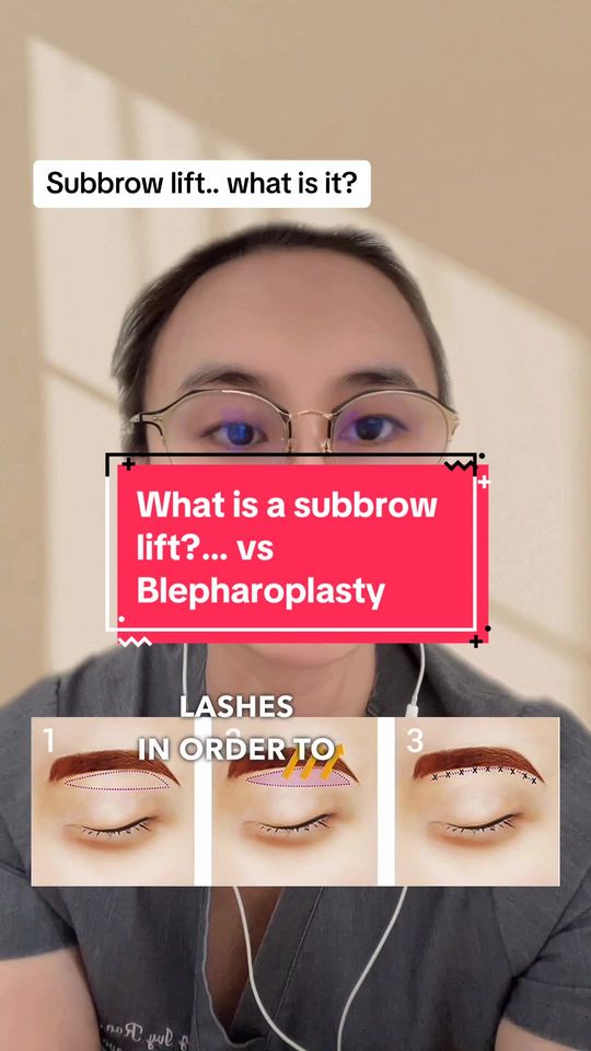 Video by Dr. Cong Ivy Ran: Sub-Brow Lift: An Alternative to Eyelid Surgery for Laxity. This is a surgery gaining popularity…