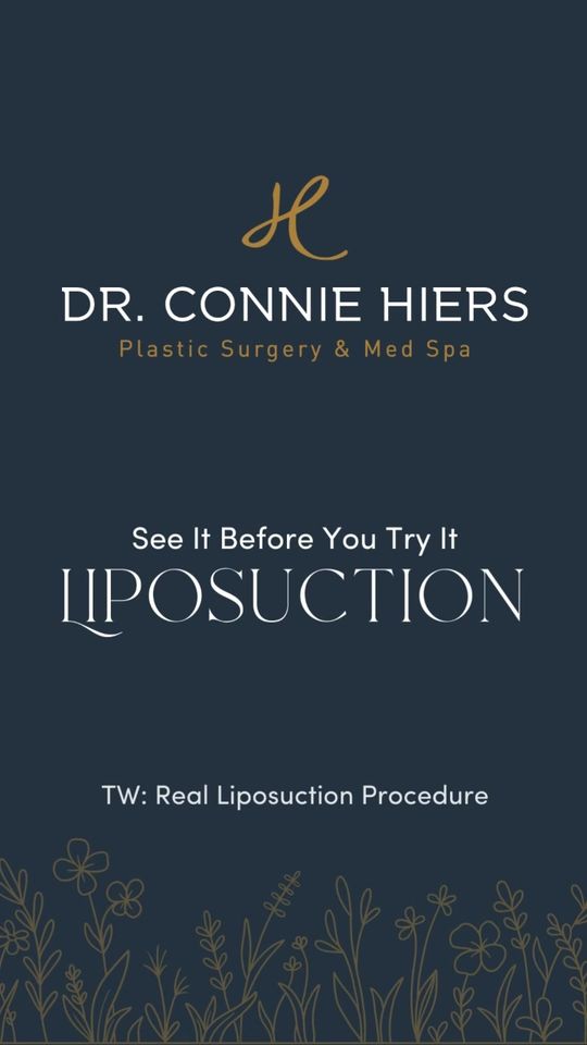 Video by Dr. Connie Hiers: Ready to sculpt your dream body? 🌟 Check out our liposuction treatment for a behind-the-scenes l…