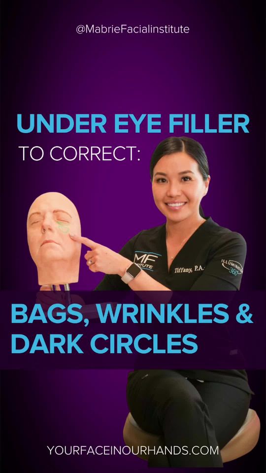 Video by Dr. David C. Mabrie: Volume loss in the midface is responsible for 3 big problems that bring people to MFI: under-eye…