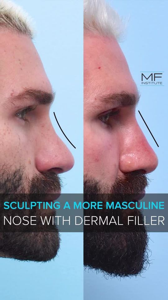 Video by Dr. David C. Mabrie: How to obtain a more masculine looking nose through a non surgical rhinoplasty (nose job).
