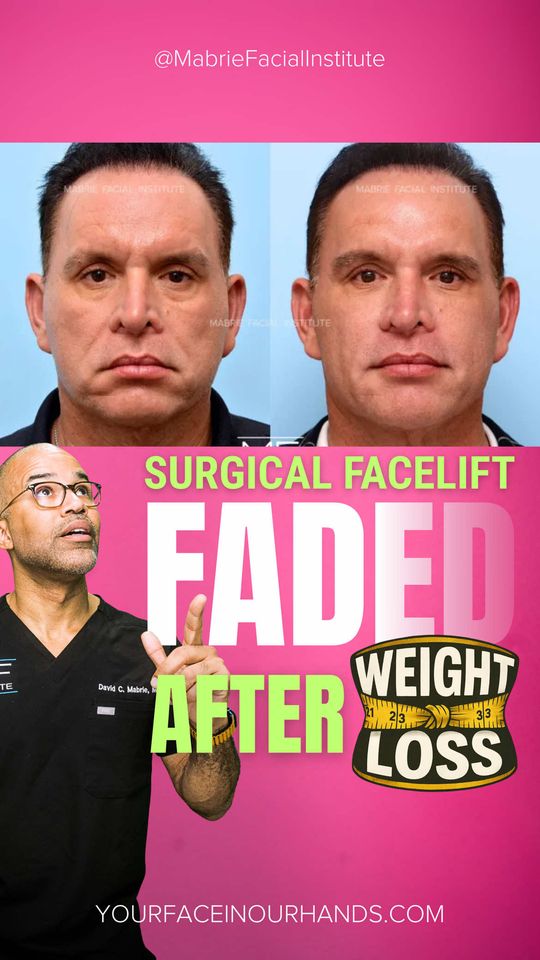 Video by Dr. David C. Mabrie: Surgical facelift results don’t always last forever. When changes return, you have options: ▪️Emb…