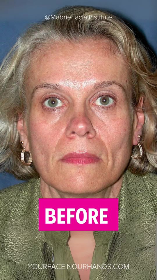 Video by Dr. David C. Mabrie: Nasolabial folds (smile lines) are natural — but when they stay deep at rest, they can age the fa…