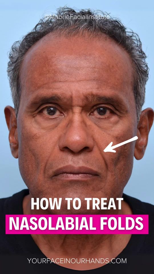 Video by Dr. David C. Mabrie: Nasolabial Folds - These Lines That Age You the Most — Here’s How We Fix Them 🙂 Tag someone who…