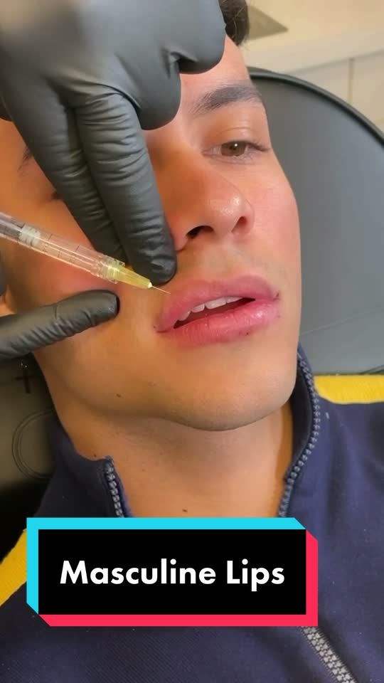 Video by Dr. David Saadat: @wobruno wanted to add volume and shape to his lips while keeping them natural Check our IG for more