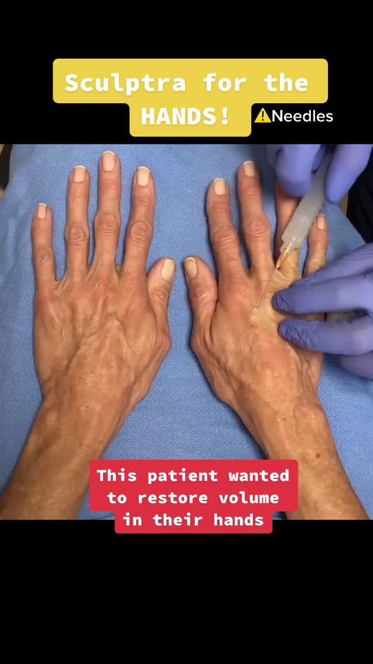 Video by Dr. David Saadat: Giving our patient’s hands a more youthful appearance 🤚🏼🤍