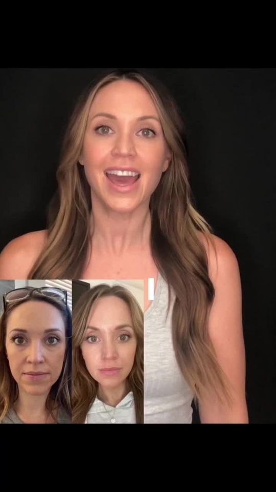 Video by Dr. David Saadat: Sculptra adding youth back to the face! After 25 you begin to loose 1-2% of collagen per year. Sc…