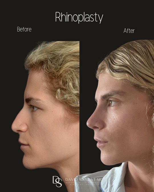 Video by Dr. David Saadat: This stunning patient came to me after breaking her nose and decided to make a few cosmetic refin…