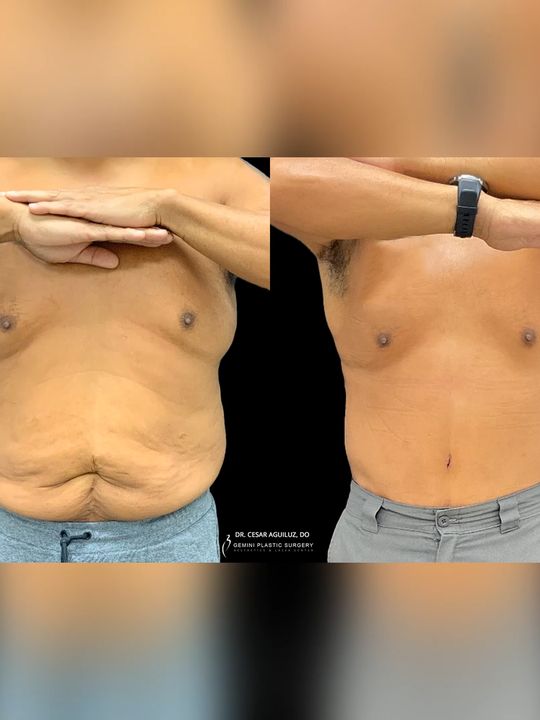 Video by Dr. Della C. Bennett: Male Tummy Tuck Age: 49-year-old, M Issue: He complained of excess skin after a massive weight lo…