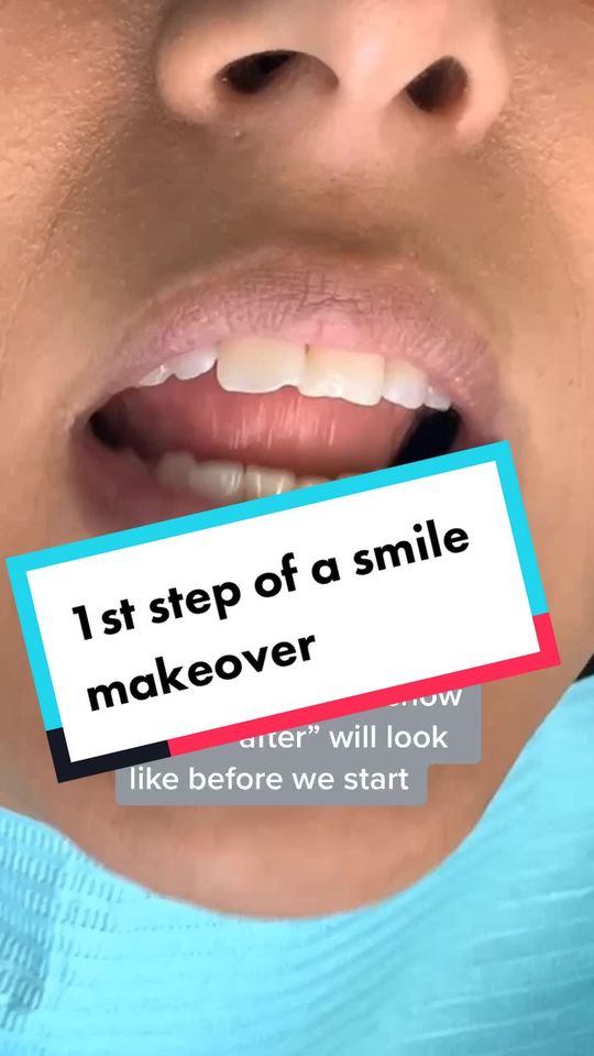 Video by Dr. Desiree Yazdan: First step of a smile makeover!