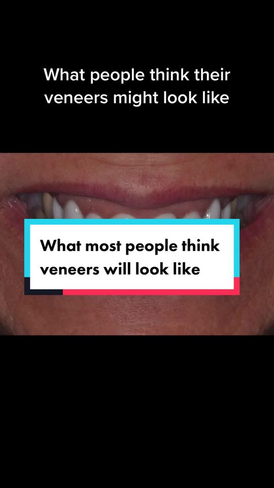 Video by Dr. Desiree Yazdan: Making veneers look natural takes a higher level of skill and a great team. You have to make sure…