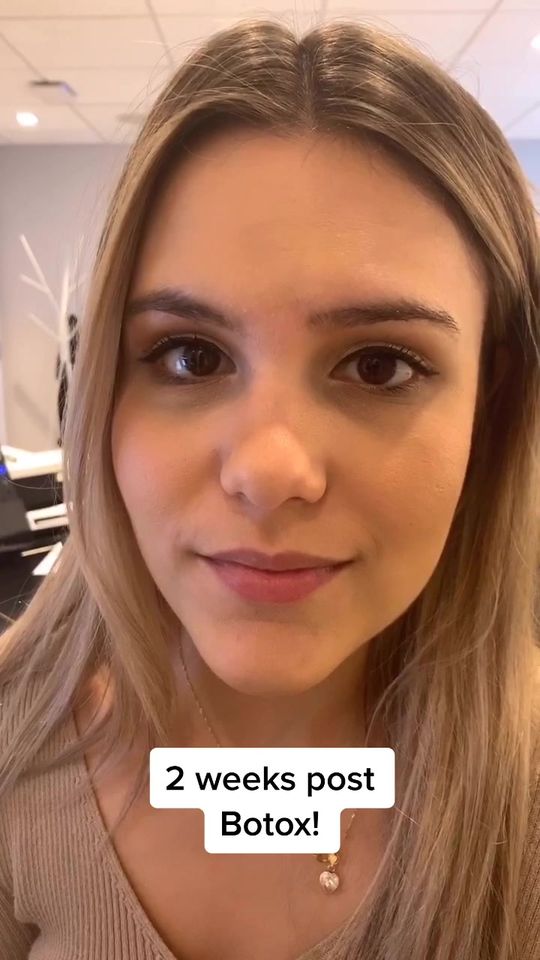 Video by Dr. Dilip D. Madnani: Look at how the Botox smooths out wrinkles and lifts her eyebrows! Botox is preventative for wrin…