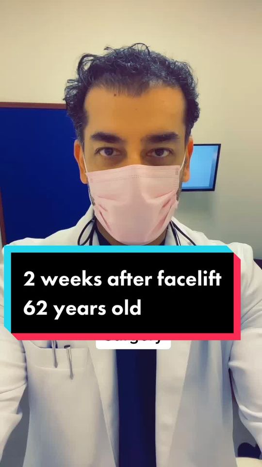Video by Dr. Dilip D. Madnani: 2 weeks after face and neck lift. 64 female looking amazing. Price $9500 -17500.
