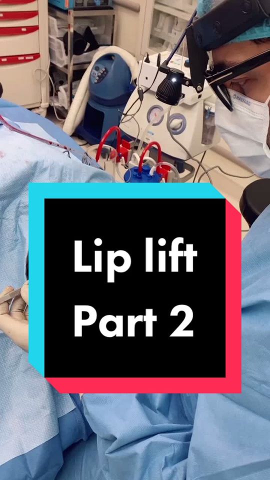 Video by Dr. Dilip D. Madnani: Lip lift explained!