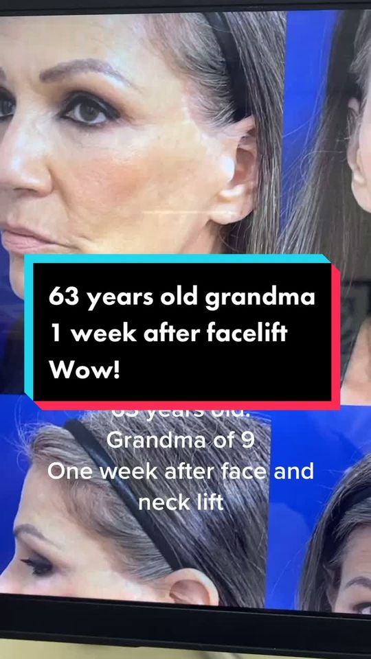 Video by Dr. Dilip D. Madnani: 63 years old one week after face and neck lift healing amazing