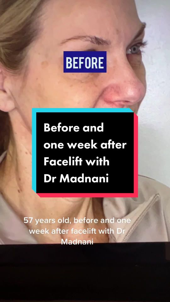 Video by Dr. Dilip D. Madnani: My lovely 57 year old patient is one week after her facelift, we posted her 3 week selfie in the…