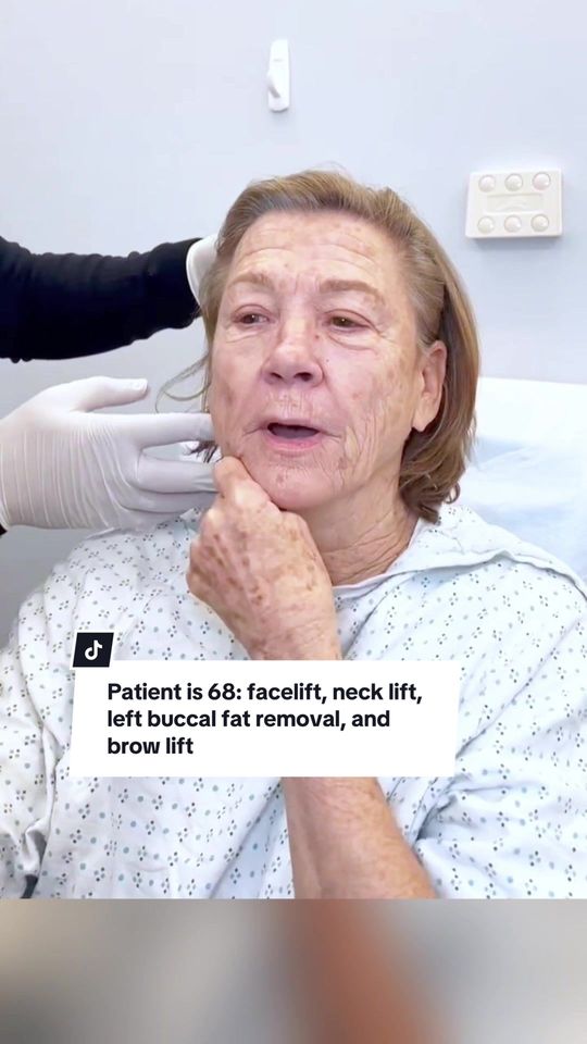Video by Dr. Dilip D. Madnani: This morning’s patient is 68 year-old and is undergoing a facelift, neck lift, left buccal fat re…